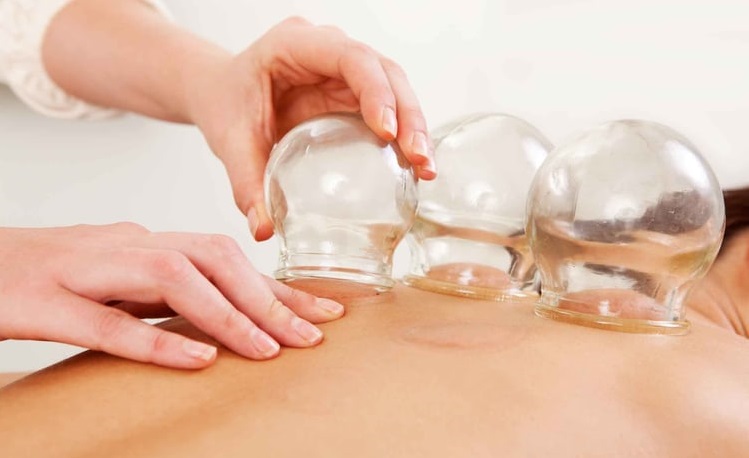 Discover the Benefits of Chinese Cupping Therapy in Singapore